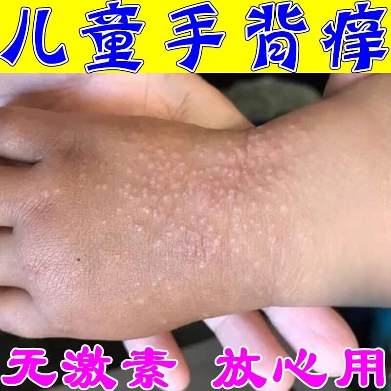 儿童手上起疙瘩过敏性焱炎皮湿痒痘痘晒伤起红小红点手背痒药膏