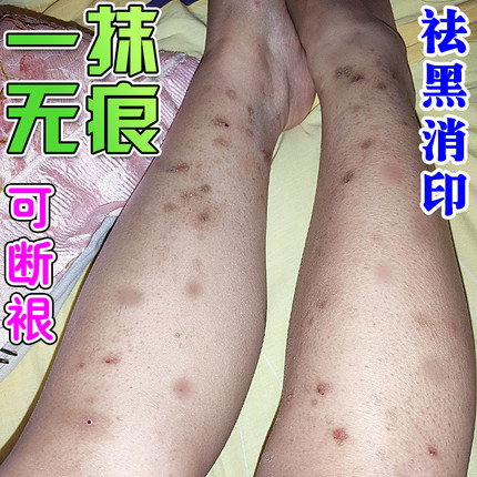 腿上挠印痘印伤烫疤痕蚊虫叮咬去黑印淡化黑色素沉淀去豆疤印消印