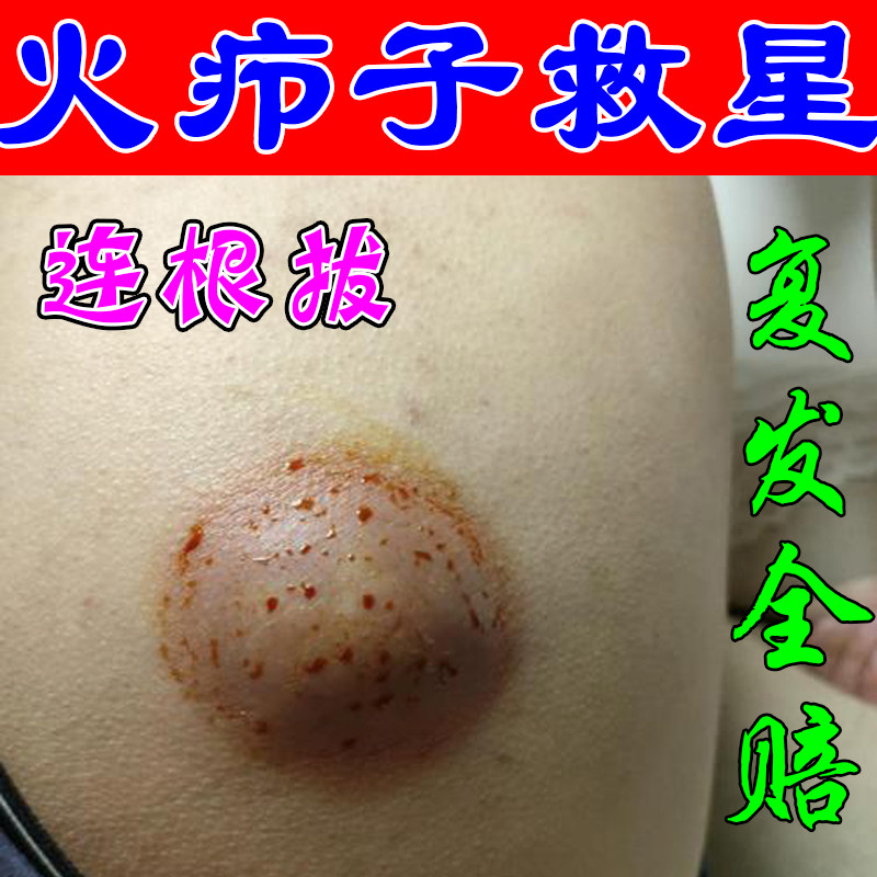 治疗火疖子的药屁股上起硬块拔毒拔脓红肿长红疙瘩脓包起痘痘痤疮