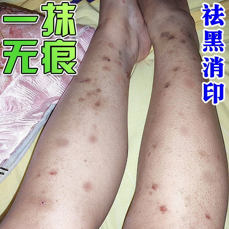 腿上挠印痘印伤去蚊虫叮咬黑印淡化黑色素沉淀烫疤痕去豆疤印消印