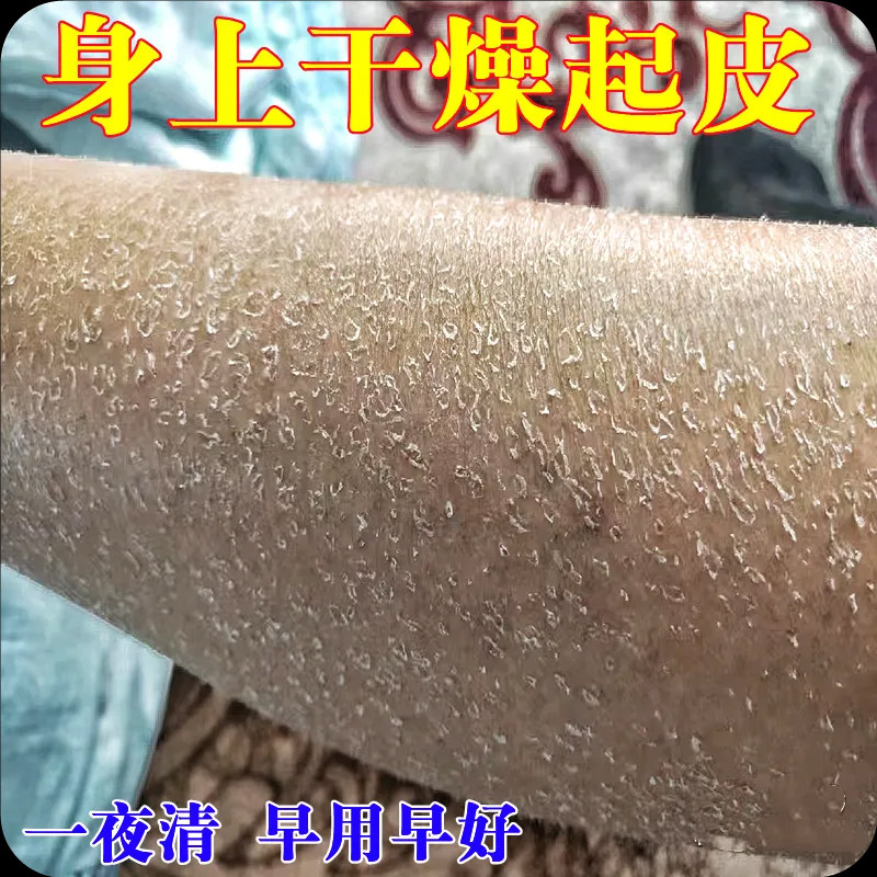 益方堂腿上干燥起皮小腿皮肤痒秋冬天起皮掉皮屑腿部鱼鳞补水保湿