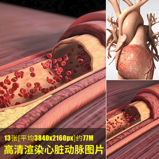 高清渲染心脏动脉图片胆固醇斑块硬化心脏发作身体动脉主动脉心室