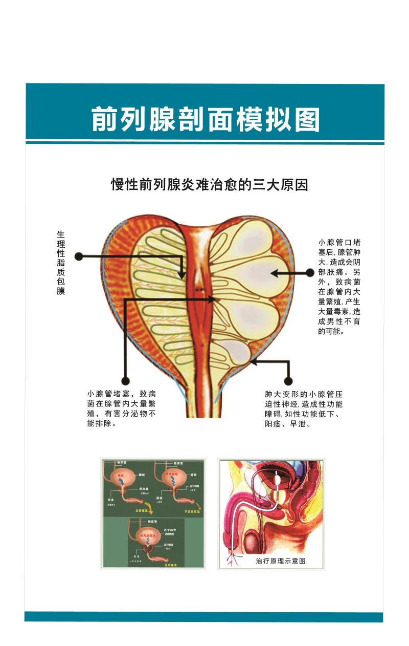海报印制展板写真医院健康知识男科挂图前列腺剖面模拟图墙贴墙纸