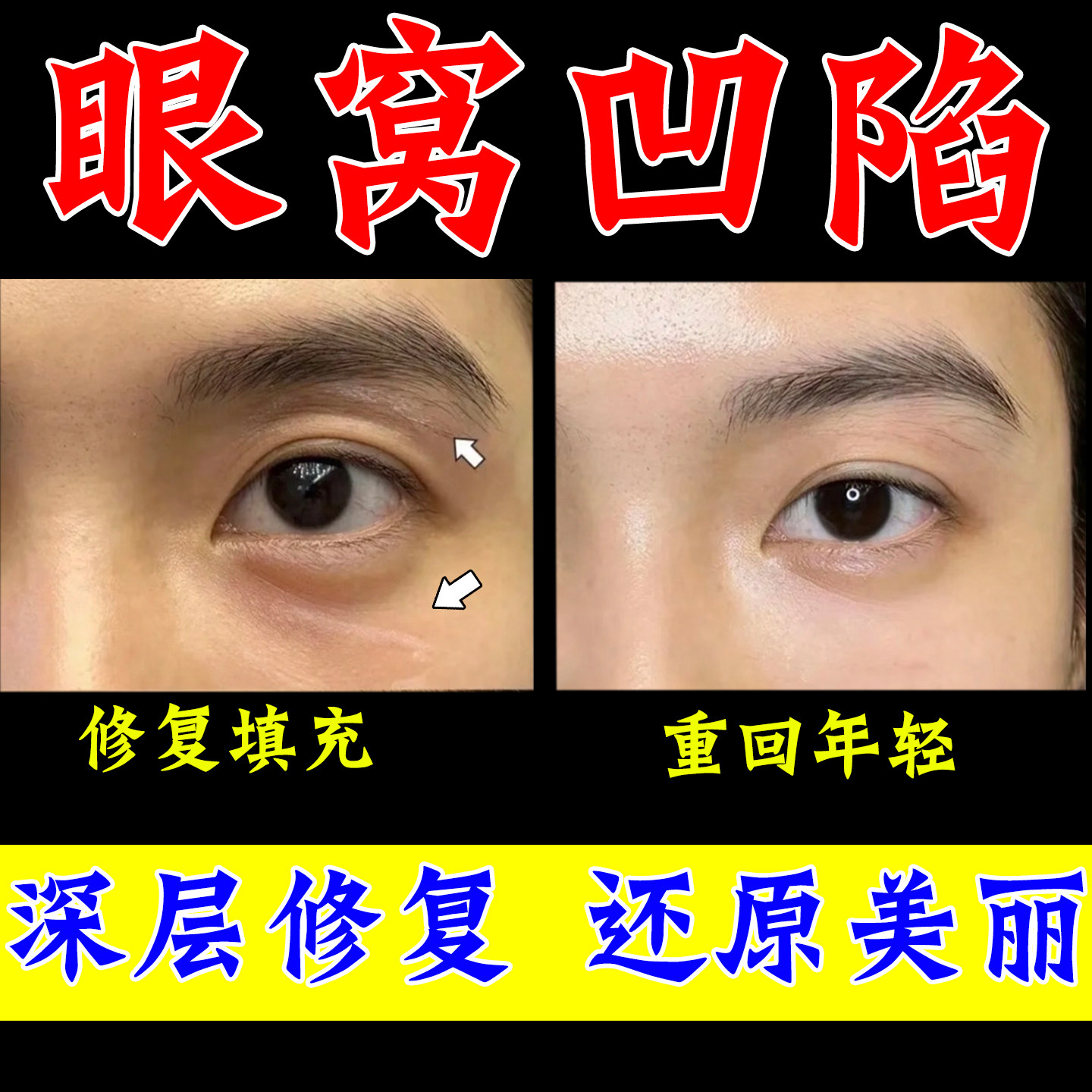 眼窝凹陷眼肌无力睁不开眼睛提拉紧致眼皮松弛眼睑下垂松弛眼膏
