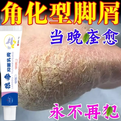 鳞屑角化型脚气专用脚后跟干裂真菌感染脱皮瘙止痒起硬皮去死皮药