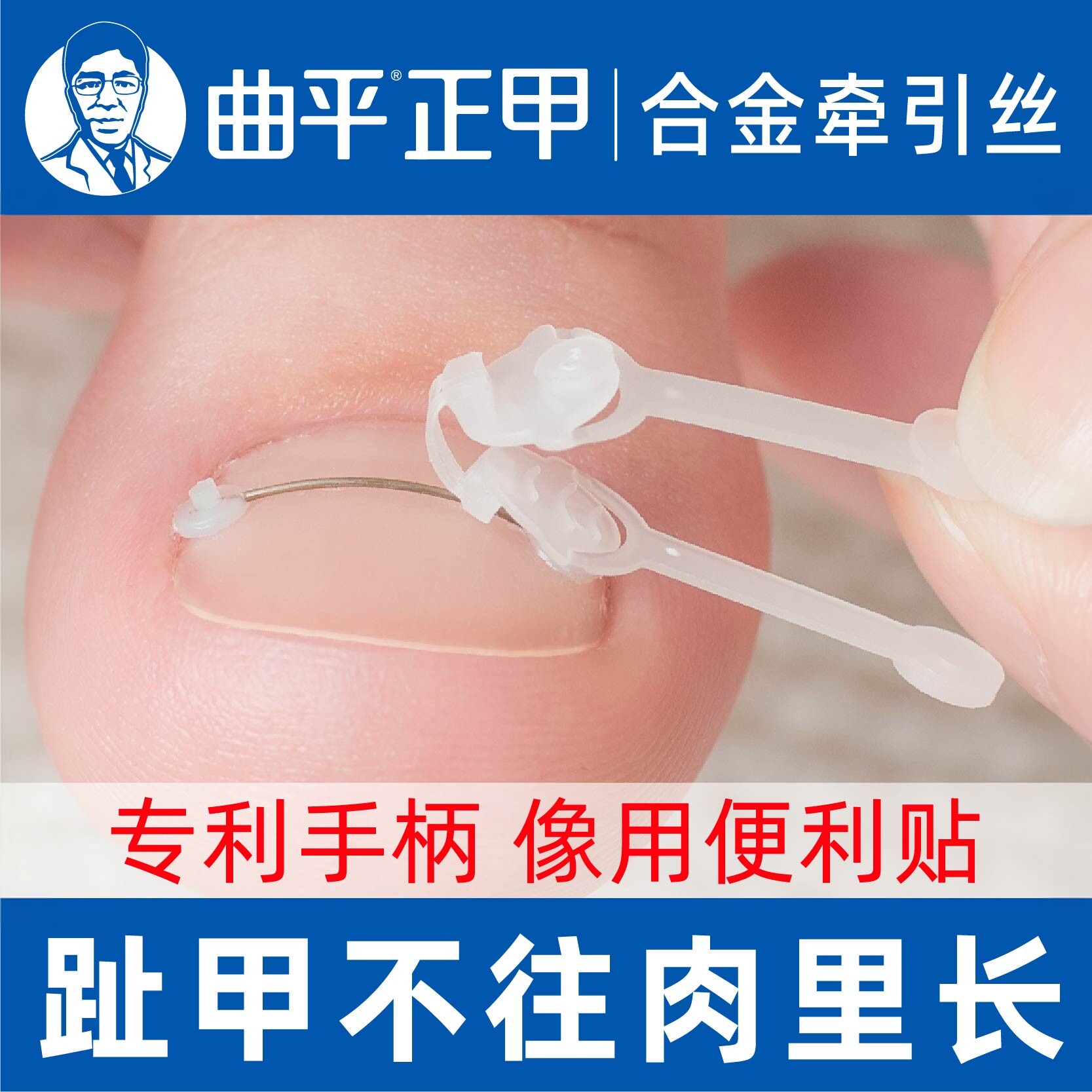 曲平医生 甲沟脚指甲嵌甲矫正器钢丝趾甲正甲贴片纠正神器炎足科