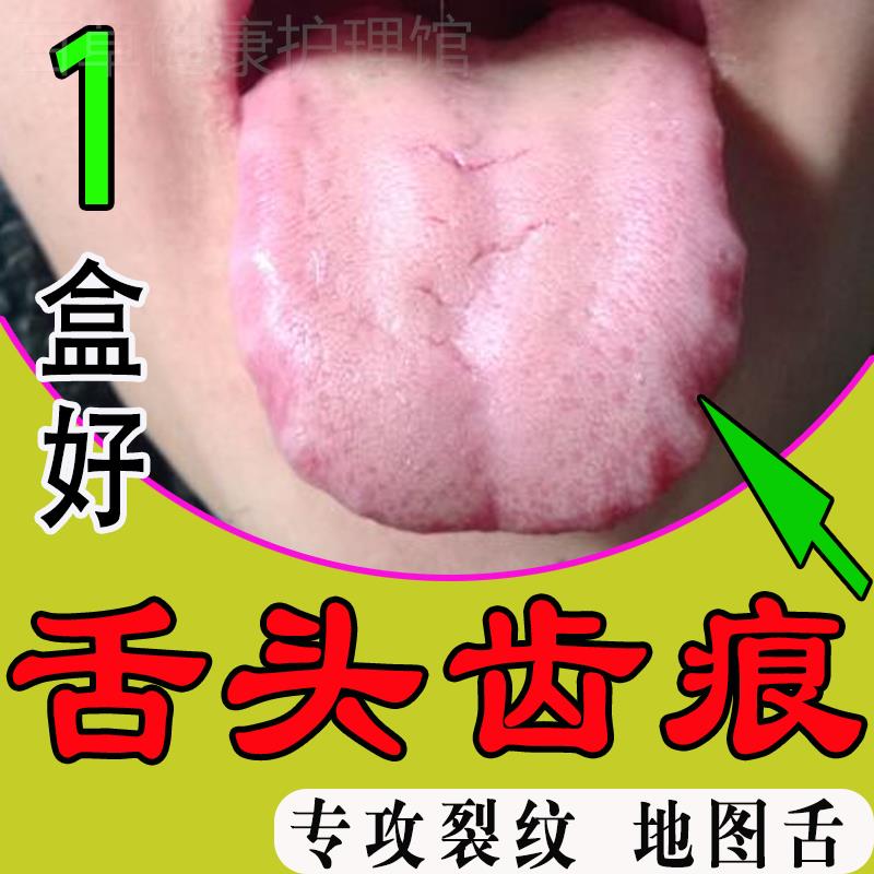 舌头有齿痕发白舌苔厚舌裂纹肿痛发炎地图舌溃烂长泡口腔扁平苔藓