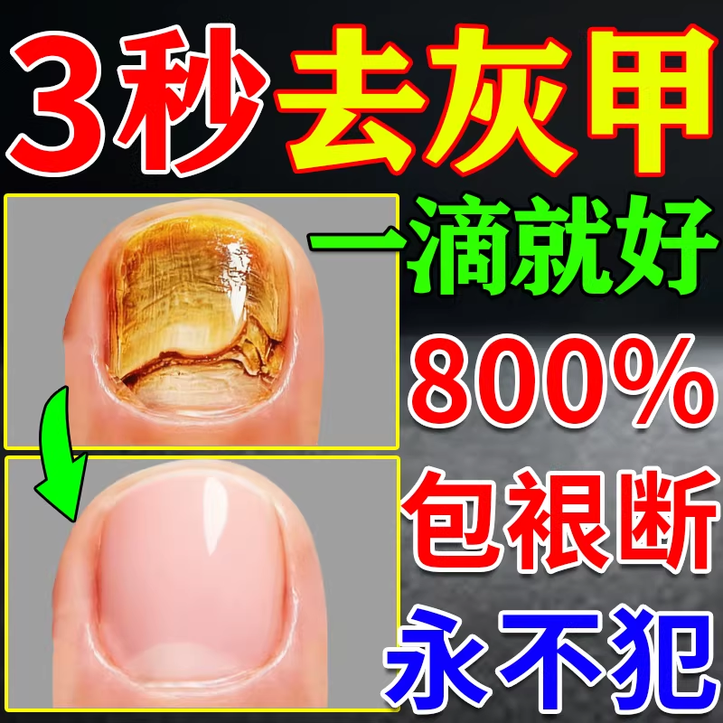灰指甲胖东来药水特效一滴净日本抑菌液脱甲膏药治疗真菌感染