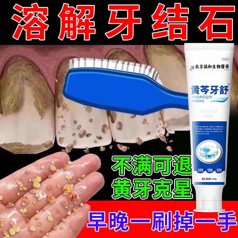 去牙结石牙膏溶解牙石专用美白去黄牙口臭牙渍牙结石清理神器VB