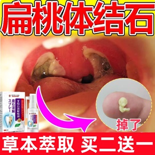 扁桃体结石去除工具隐窝冲洗器口腔异味异物感清理结石漱口水喷剂