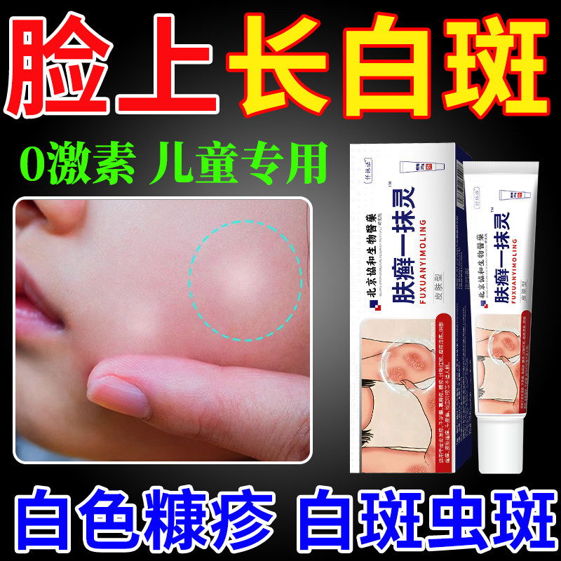 白色糠疹儿童脸上长白斑小孩汗斑皮肤瘙痒去癣桃花癣可搭膏药贴cj