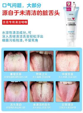 舌苔洁啫喱清新29114口缝气去黄牙口清臭清洗器刮苔去舌刷光光男