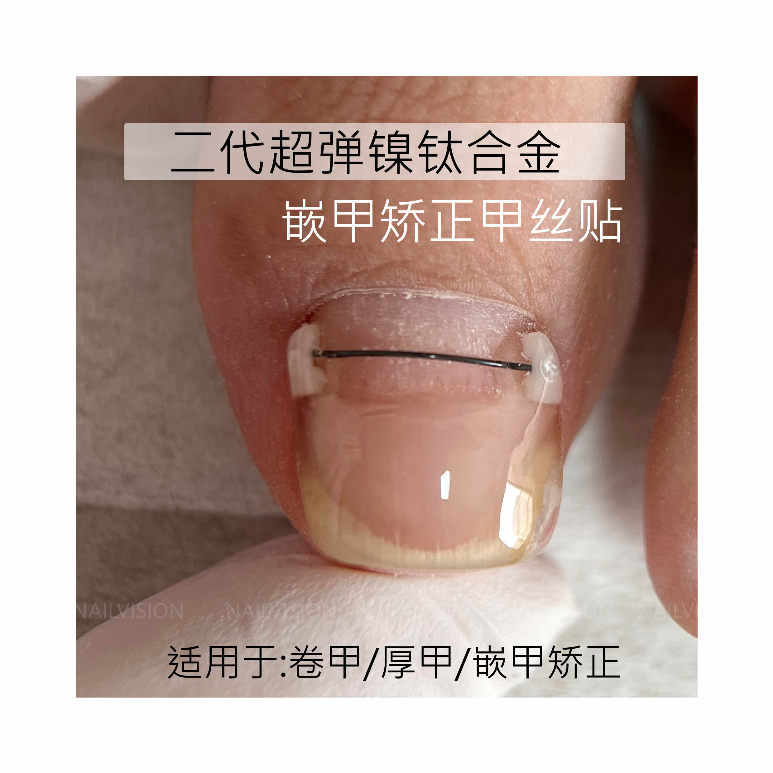 弹丝矫正器嵌甲甲沟钛合金足科