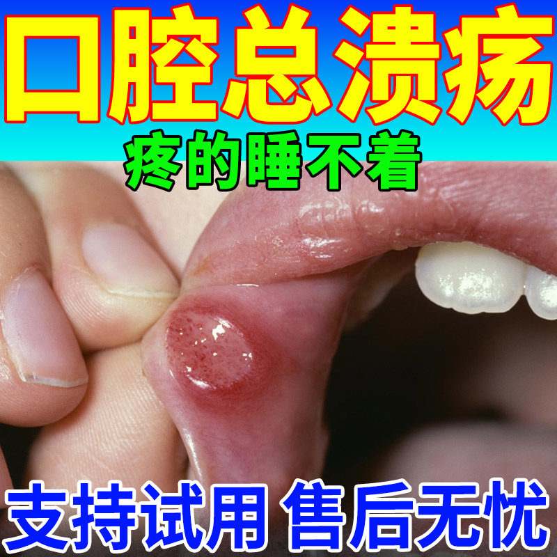 防口腔溃疡专用牙膏治牙周炎口腔出血肿痛起泡烂舌生疮益生菌牙膏
