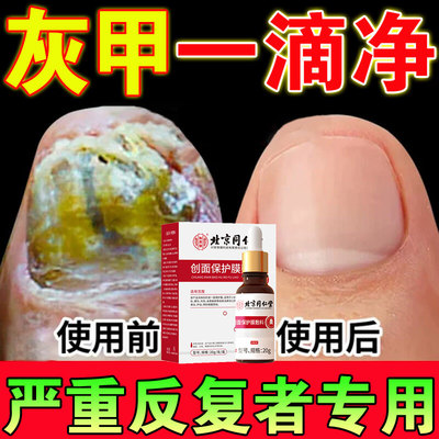 北京同仁堂灰指甲一滴净抑菌液阿莫罗芬搽剂灰特根液体敷料效治