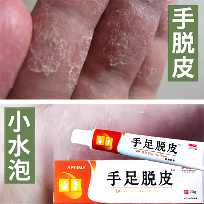 手足脱皮膏手指上起皮干燥爆皮儿童手掌蜕皮手心手脚掉皮褪头专用