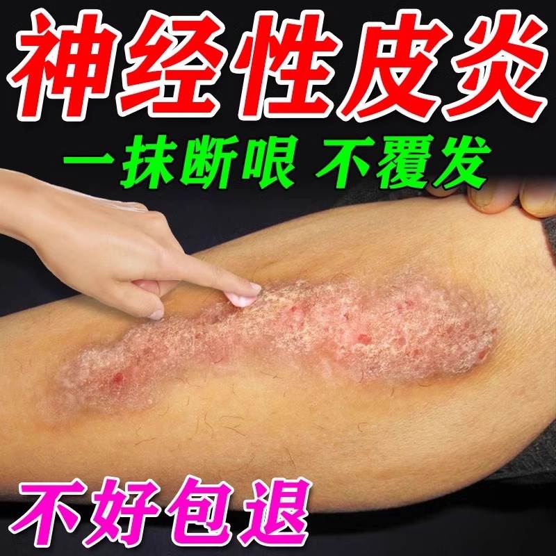 治疗神经性皮炎去祛根除外用膏日光性脂溢性皮炎顽固无激素外用膏