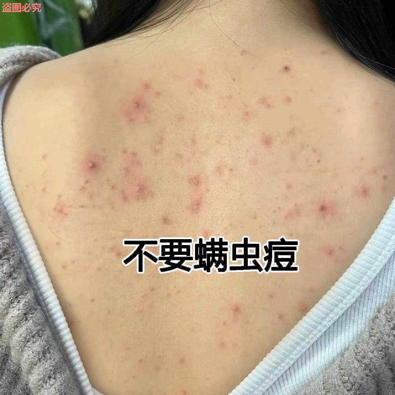 小红书推荐~买一送一~背部去螨虫沐浴露不要后背豆豆和豆豆说拜拜高性价比高么？