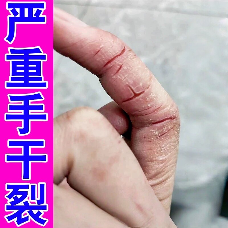 手指头裂口子脱皮开裂修复霜治手裂的药换季干燥蜕皮真菌感染粗糙
