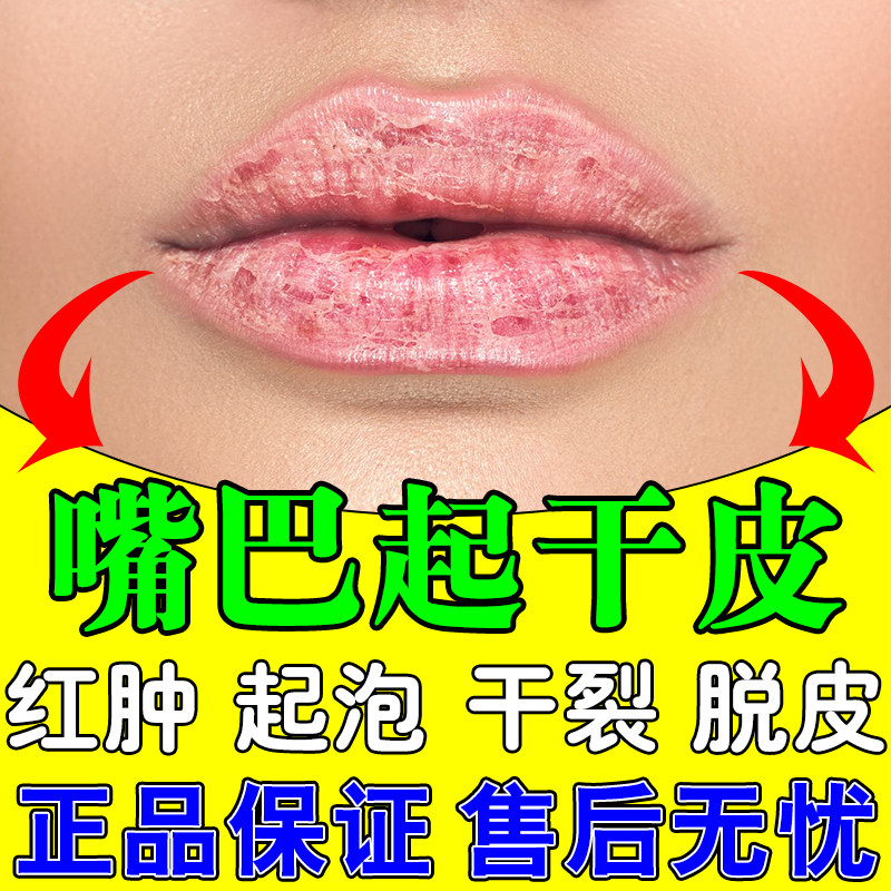 唇炎专用药膏无激素羊胡子疮起泡疹小孩舔嘴唇周炎上火烂嘴专用膏