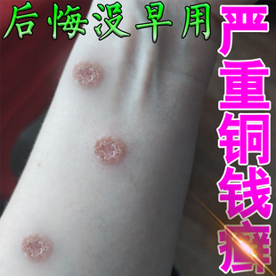 铜钱痒金钱专用膏药治疗皮肤痒圆形红斑外用皮肤发痒红痒修复乳膏