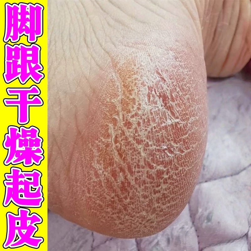 脚后跟干裂真菌感染起硬皮足跟开裂干燥脱皮鳞屑角化型脚气修复霜