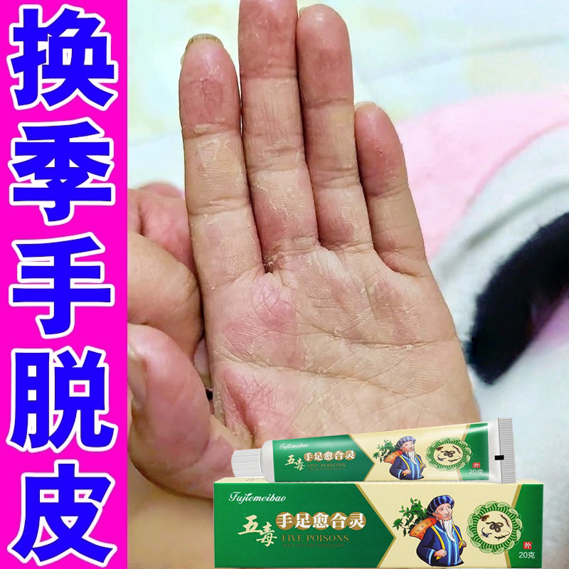 手脱皮专用药膏真菌感染儿童手脱皮手藓干裂季节性蜕皮干燥起皮药