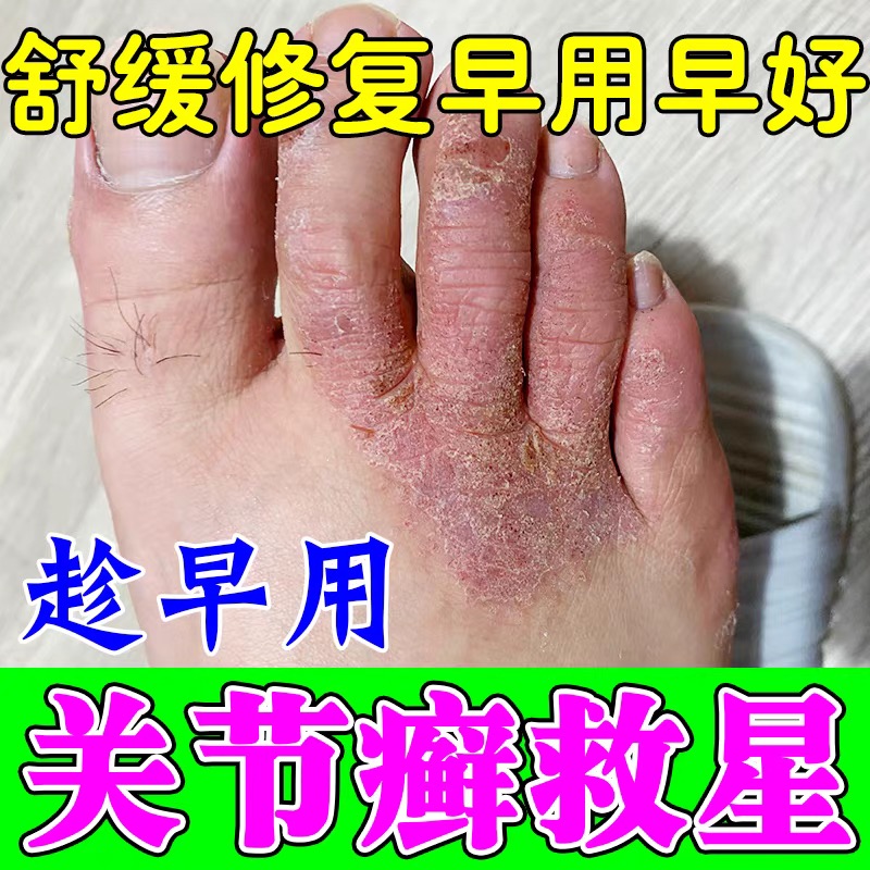脚趾头关节长癣痒脚背痒脱皮掉屑真菌感染关节皮肤溃烂干裂起硬皮