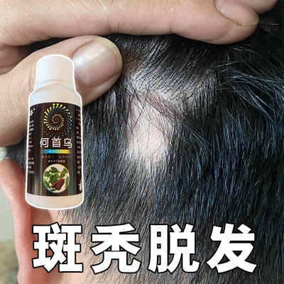 鬼剃头喷剂后脑勺小块秃掉发毛儿童囊受损修复头发再生斑秃育发液