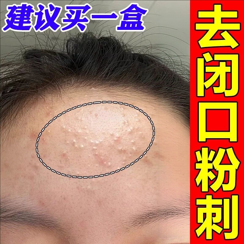 粉刺闭口去除脸部脸上长痘起小痘痘逆光闭合粉刺额头痘粉刺清肤霜