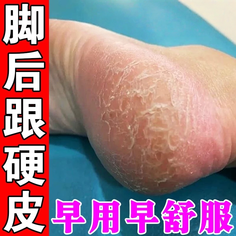 脚后跟干裂起硬皮真菌感染修复霜足跟开裂角质增厚去死皮脱皮药膏
