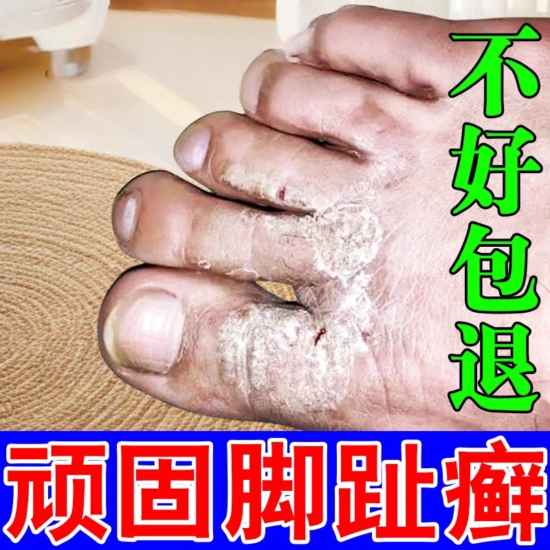 脚趾癣脚背痒脚面脚趾头上长癣脱屑苔藓湿疹皮炎皮肤发痒杀菌特效