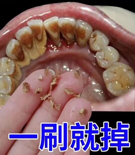 【一刷掉一嘴】溶解牙结石去掉牙渍牙垢美白牙膏洗牙神器去牙渍牙