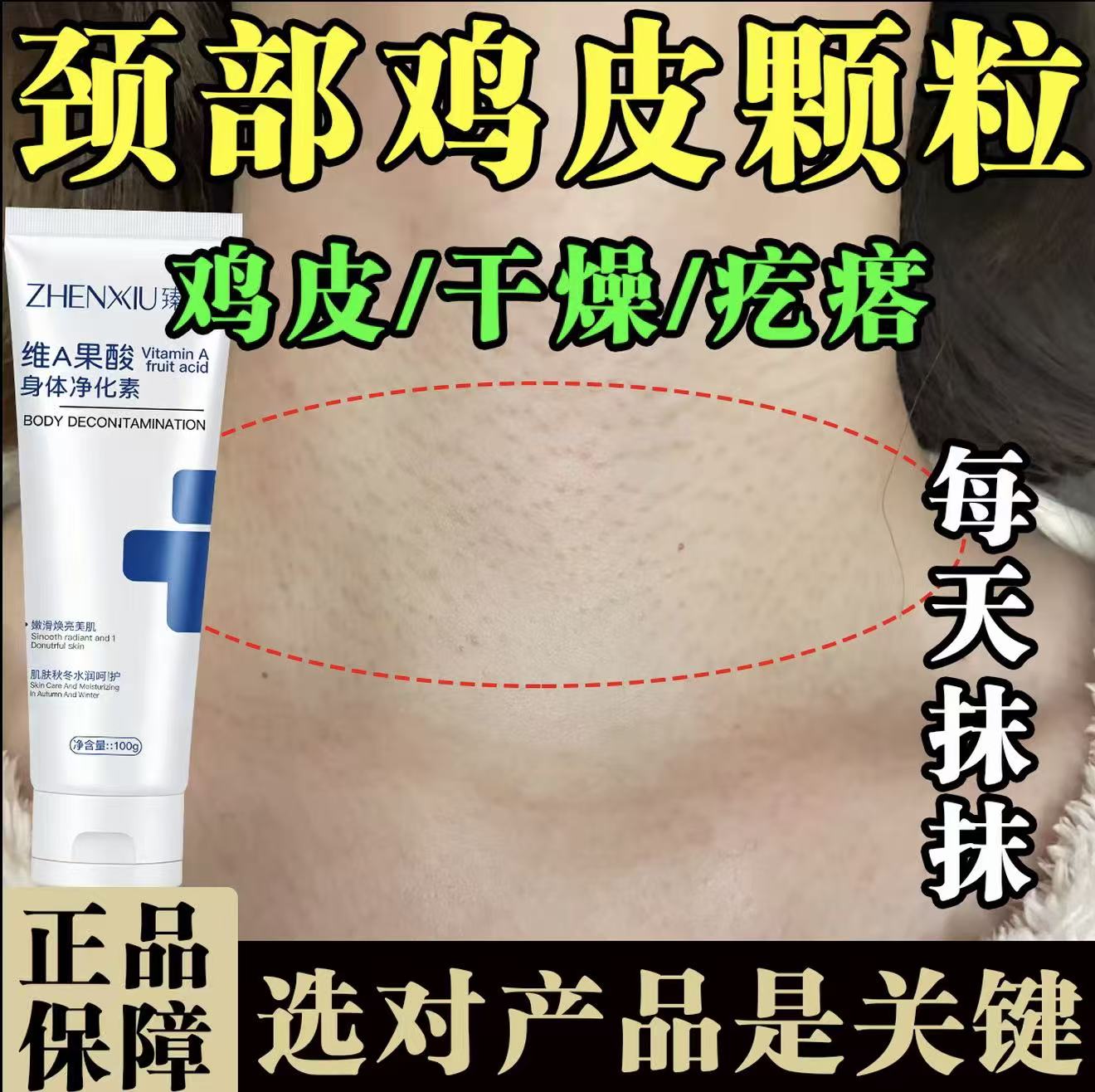 胳膊腿上手臂鸡皮疙瘩小颗粒毛囊堵塞黑点全身皮肤干燥粗糙净化素