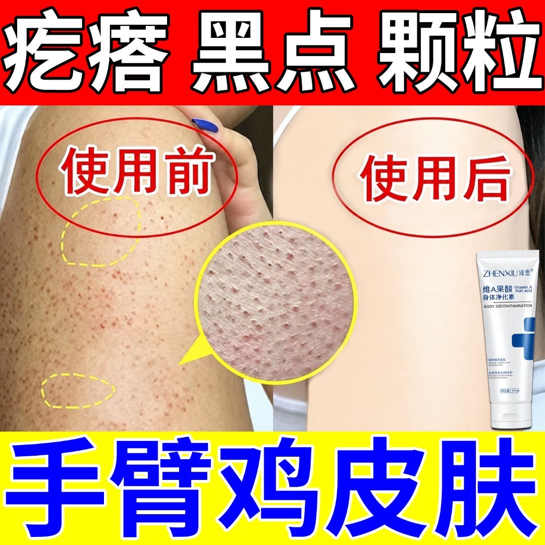 胳膊腿上手臂鸡皮疙瘩小颗粒毛囊堵塞黑点全身皮肤干燥粗糙净化素
