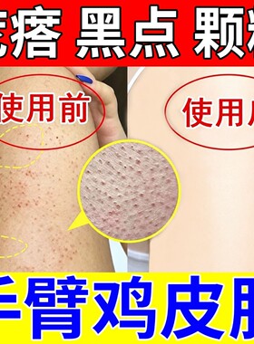 胳膊腿上手臂鸡皮疙瘩小颗粒毛囊堵塞黑点全身皮肤干燥粗糙净化素