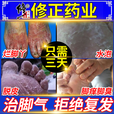 治疗脚气止痒脱皮杀菌脚气止痒脱皮烂脚丫用药去真菌感染水泡型BF