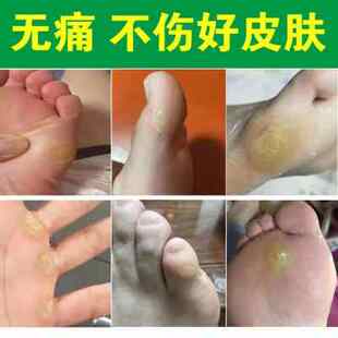 去脚趾头老茧脚茧神器去除脚掌老茧子死皮软化剂厚硬皮脚底脚垫根