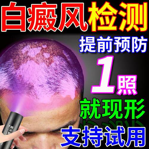 白癜风检测灯面部皮肤白斑家用鉴定仪医院同款荧光真菌紫光伍德灯