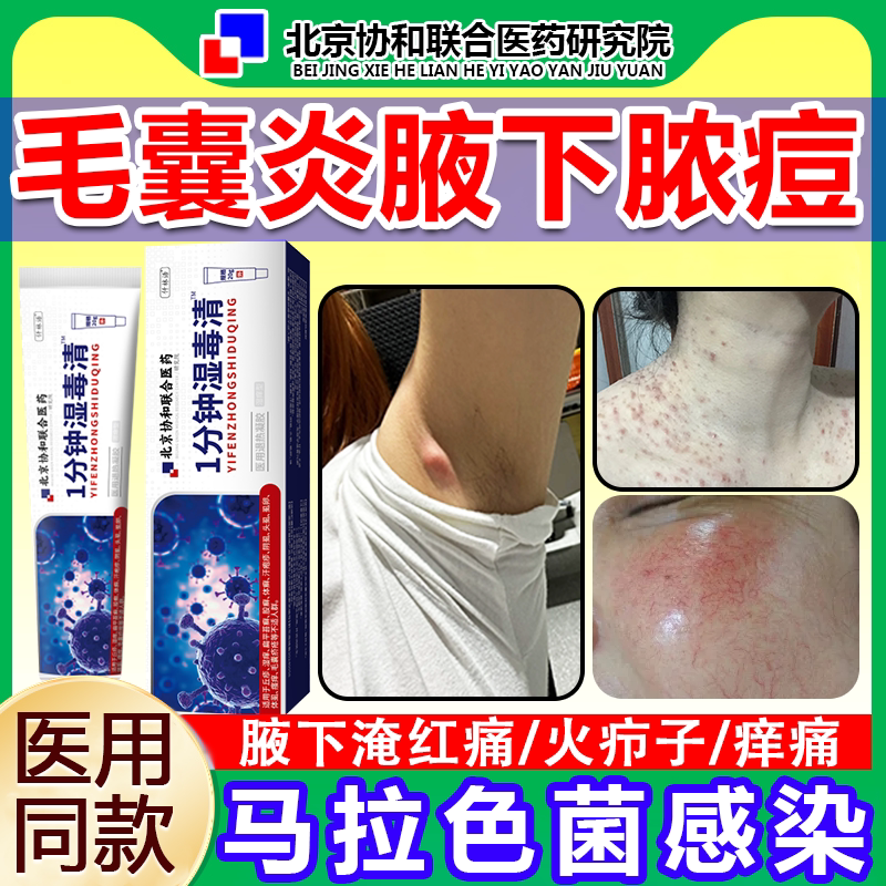 腋下长痘痘毛囊炎马拉色菌脓包腋窝胳肢窝火疖子硬疙瘩拔毒脓膏wg