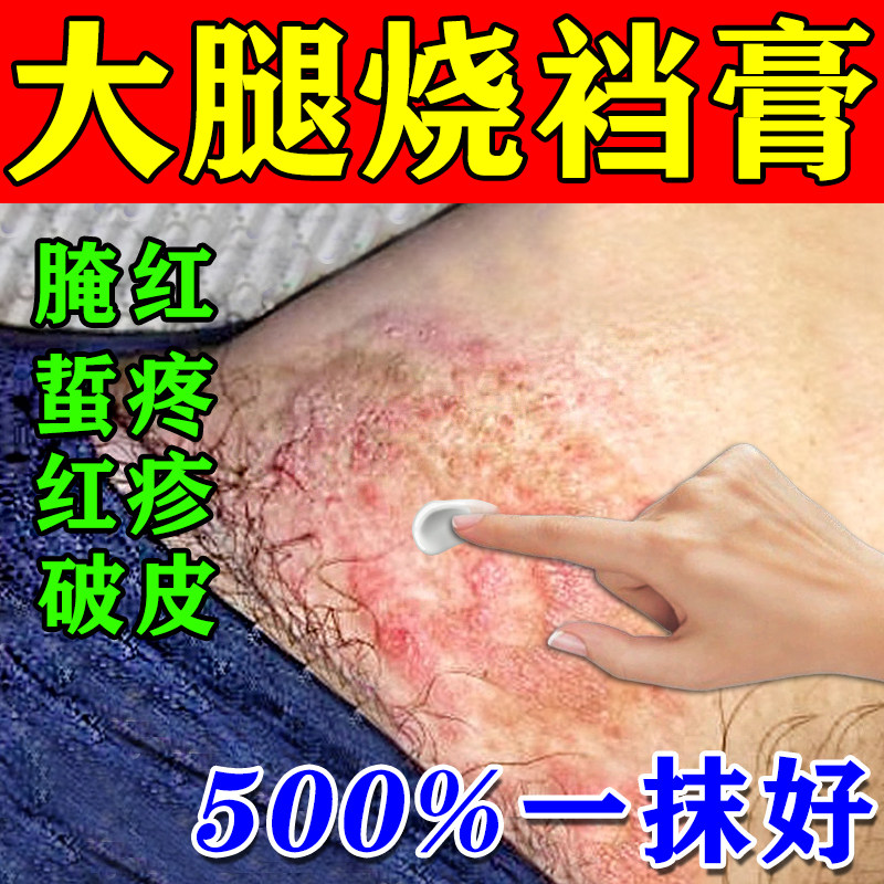 烧裆药防胖人夏天走路大腿内侧摩擦膏男女士出汗红肿刺痛发痒神器