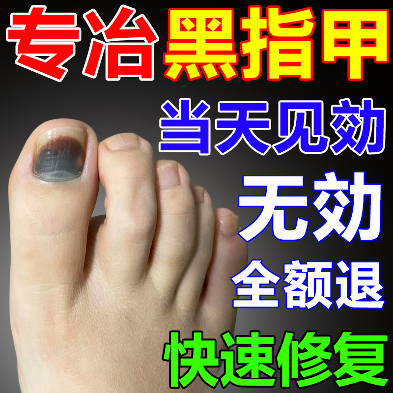 治疗黑指甲灰甲一滴甲母痣真菌性白甲脚指甲盖变厚修复液受损再生