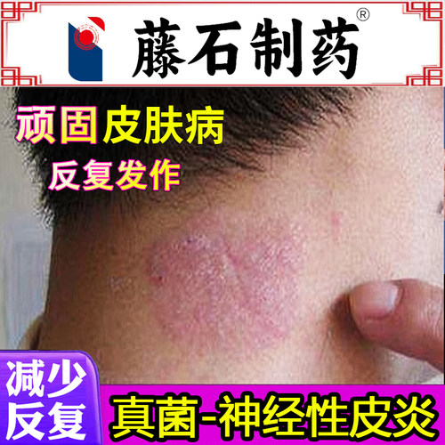 【药监备案】神经性皮炎顽固瘙痒