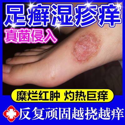 足癣脚癣藓真菌感染脚止痒湿疹