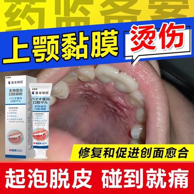 上颚烫伤口腔黏膜溃疡疼痛凝胶