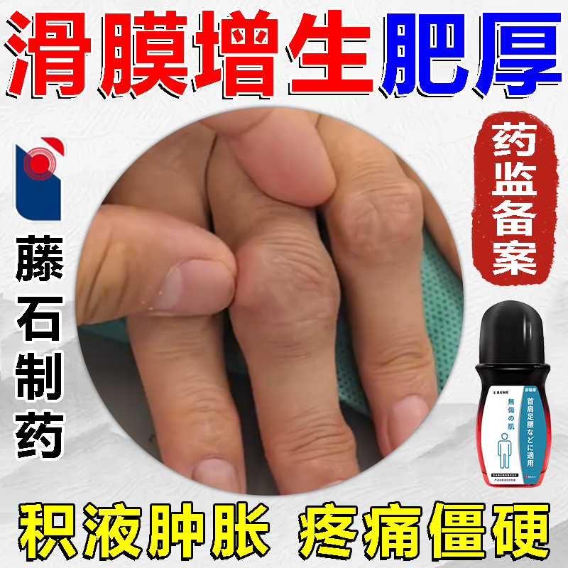 关节滑膜增生肥厚积液肿胀