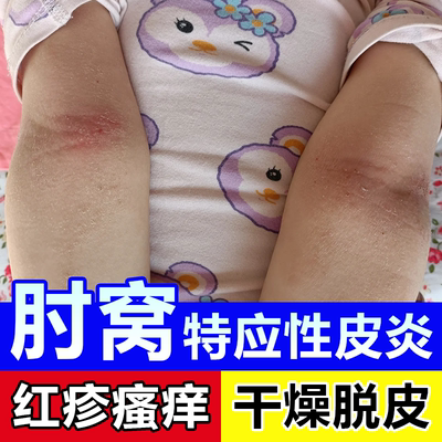 手肘窝特应性皮炎红疹瘙痒脱皮