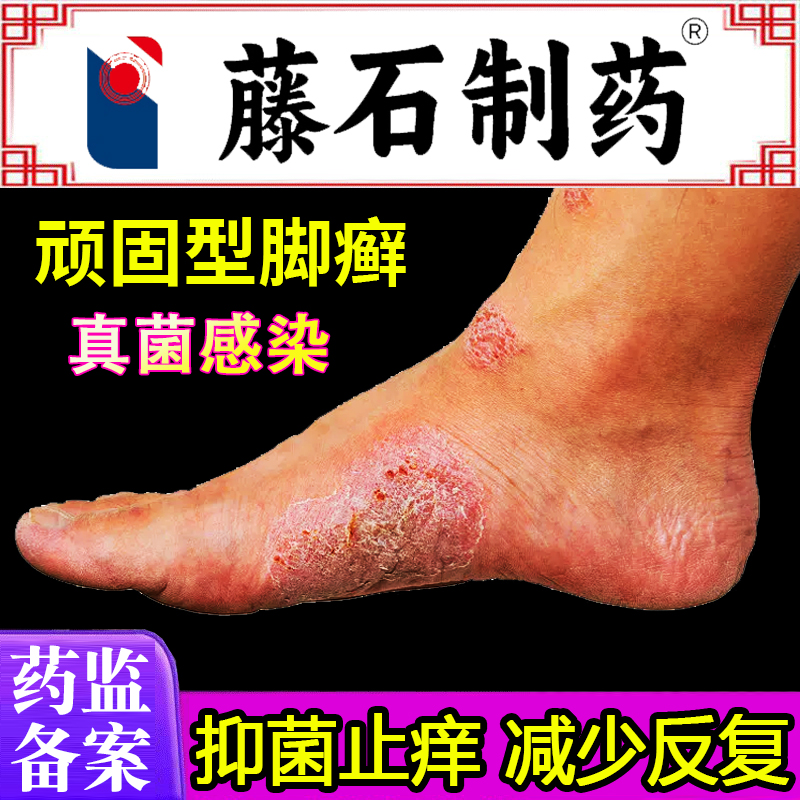 【壳聚糖抑菌止痒】顽固脚癣专研