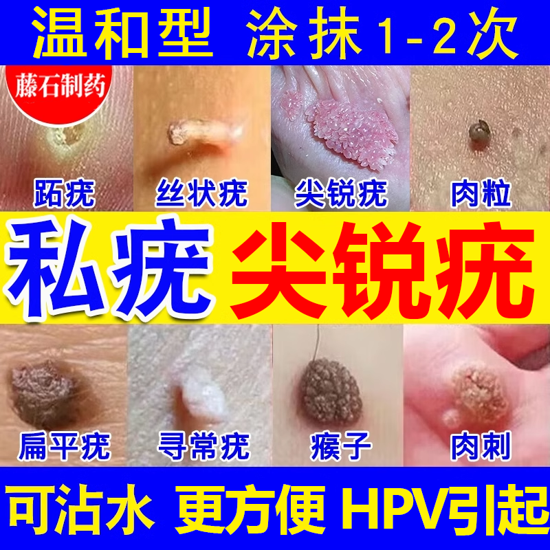 去疣膏私处斩草除锐湿疣菜花状根一抹灵扁平疣猴子去除无忧wg