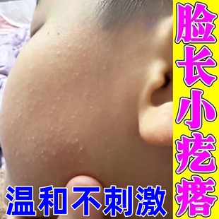 儿童脸上起小疙瘩长白头小颗粒去除闭口粉刺脂肪粒毛囊角化专用膏